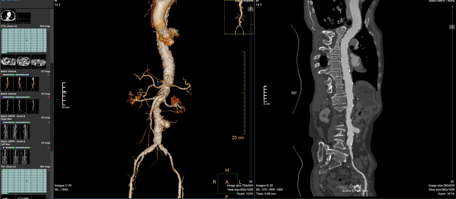 3 Hình ảnh MSCT hệ động mạch chủ ngực bụng chậu
